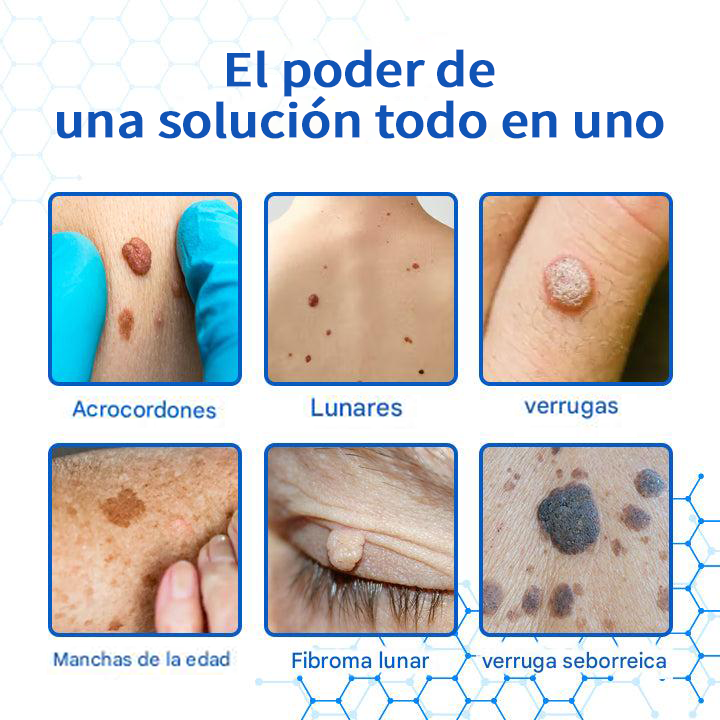 Mresio® DermZap Mole & Wart Removal Laser Pen💎
