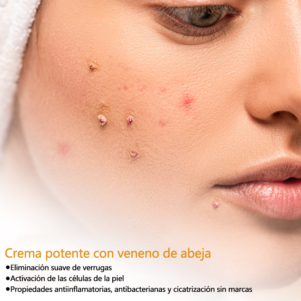 🐝Twinsun™ Súper Crema Potente con Veneno de Abeja, ¡aprobada por la EMA! 💖Perfecta para tratar verrugas, bultitos en la piel, infecciones, queratosis… ¡y para dejarte la piel suave y uniforme!
