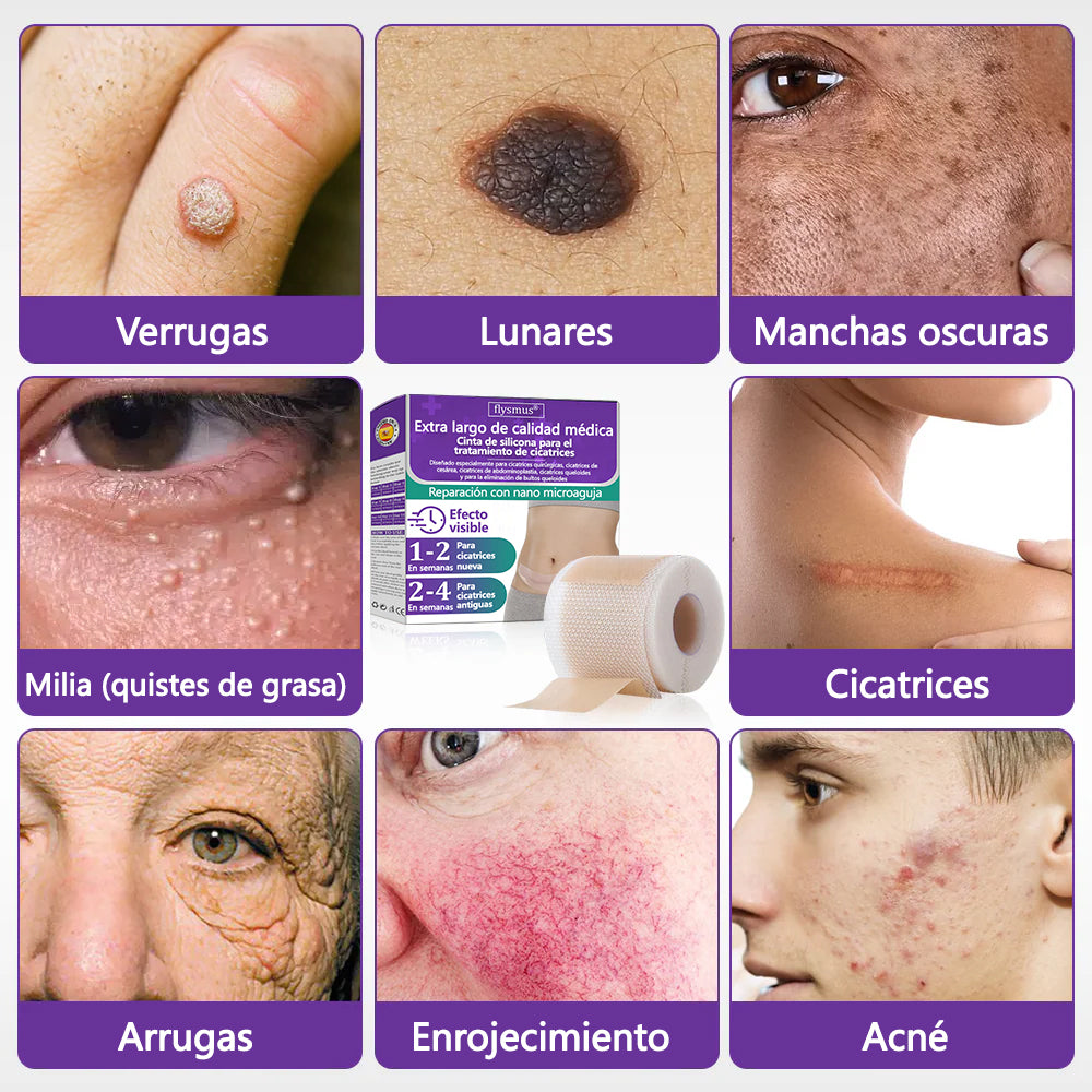 🏷️ Tienda Oficial: Flysmus® ReGen Cinta de Microneedles con Ácido Hialurónico Nano-Heal 💝 Tratamiento de cicatrices nuevas y antiguas, reducción de cicatrices quirúrgicas, estrías, queloides, acné, quemaduras, verrugas, dermatomas y venas varicosas 🌼