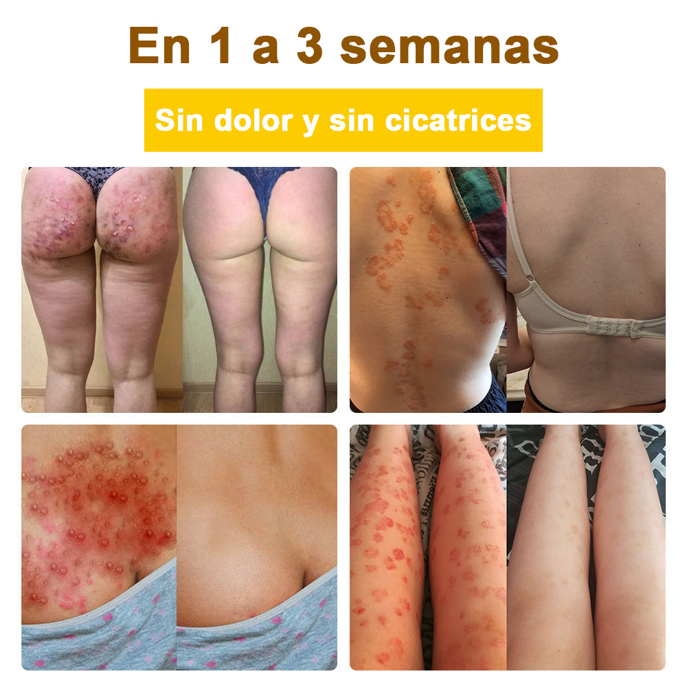 Crema cicatrizante ✅flysmus™ con veneno de abeja🐝: Tratamiento de eczemas, psoriasis, acné, rosácea, infecciones fúngicas y verrugas