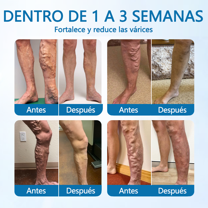 💚 Trimil® VeinGuard spray de hierbas – ✅ ¡Clínicamente probado para reducir las varices en solo 7 días! (avalado por la Agencia Europea de Medicamentos – EMA)🌿