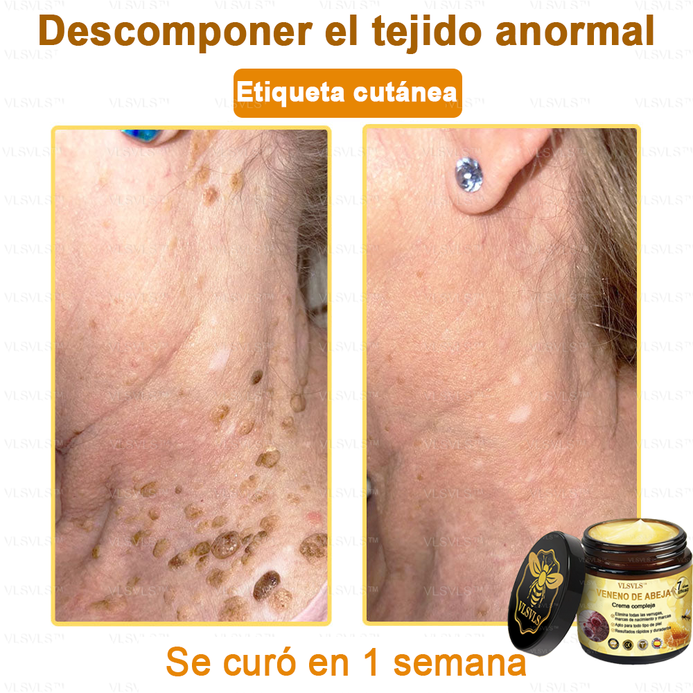 VLSVLS™ Crema con Veneno de Abeja de Efecto Completo 🧑⚕️ Recomendado por Dermatólogos - Para el Tratamiento de Diversos Problemas de la Piel🐝