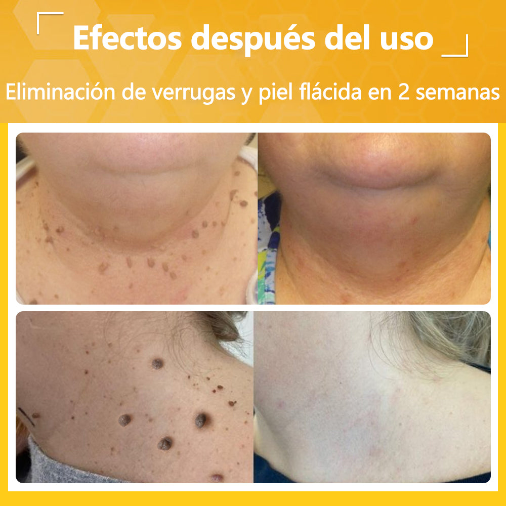 🐝Twinsun™ Súper Crema Potente con Veneno de Abeja, ¡aprobada por la EMA! 💖Perfecta para tratar verrugas, bultitos en la piel, infecciones, queratosis… ¡y para dejarte la piel suave y uniforme!
