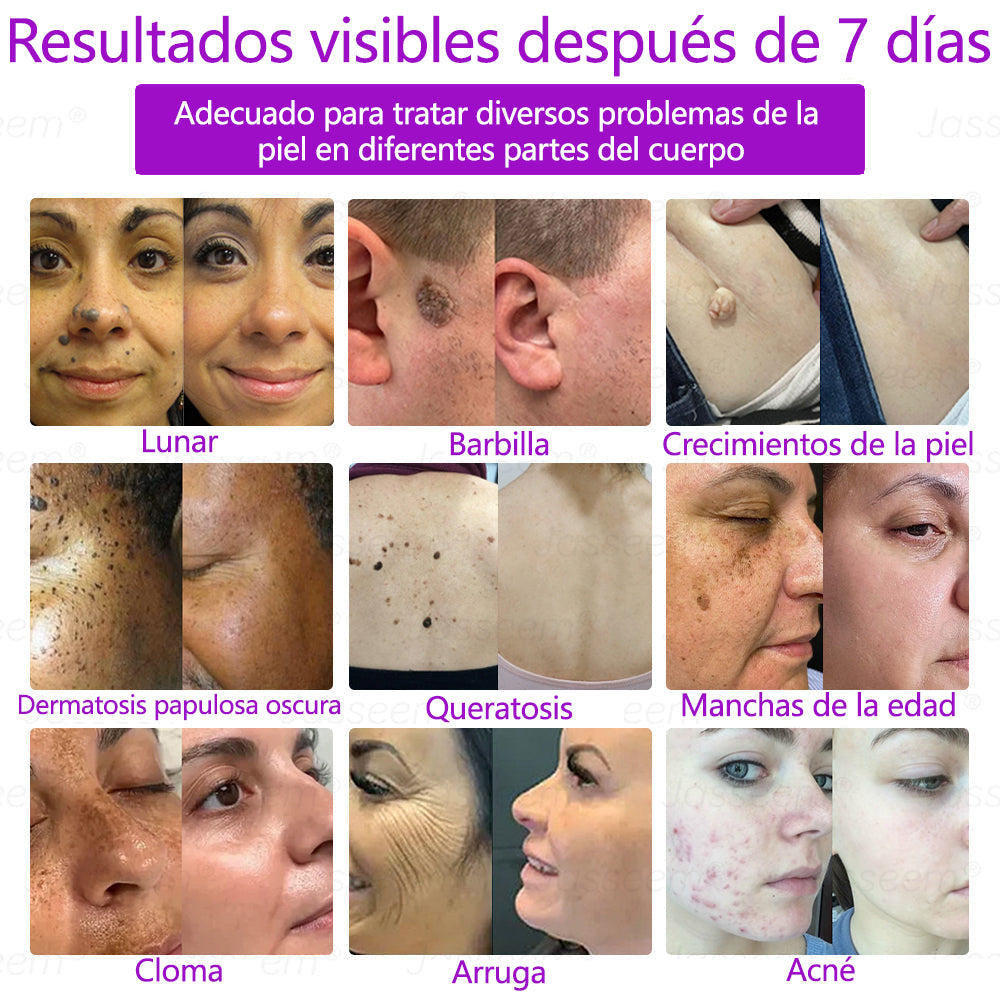 𝐉𝐚𝐬𝐬𝐞𝐞𝐦® Bolígrafo láser CO₂ avanzado y no invasivo para el cuidado de la piel 🛫 (Elimina suavemente verrugas, lunares, manchas de la edad y bultitos en la piel – ¡sin dolor y sin complicaciones!) 🛫