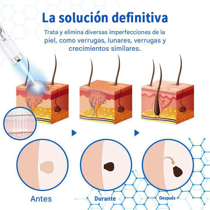Mresio® DermZap Mole & Wart Removal Laser Pen💎