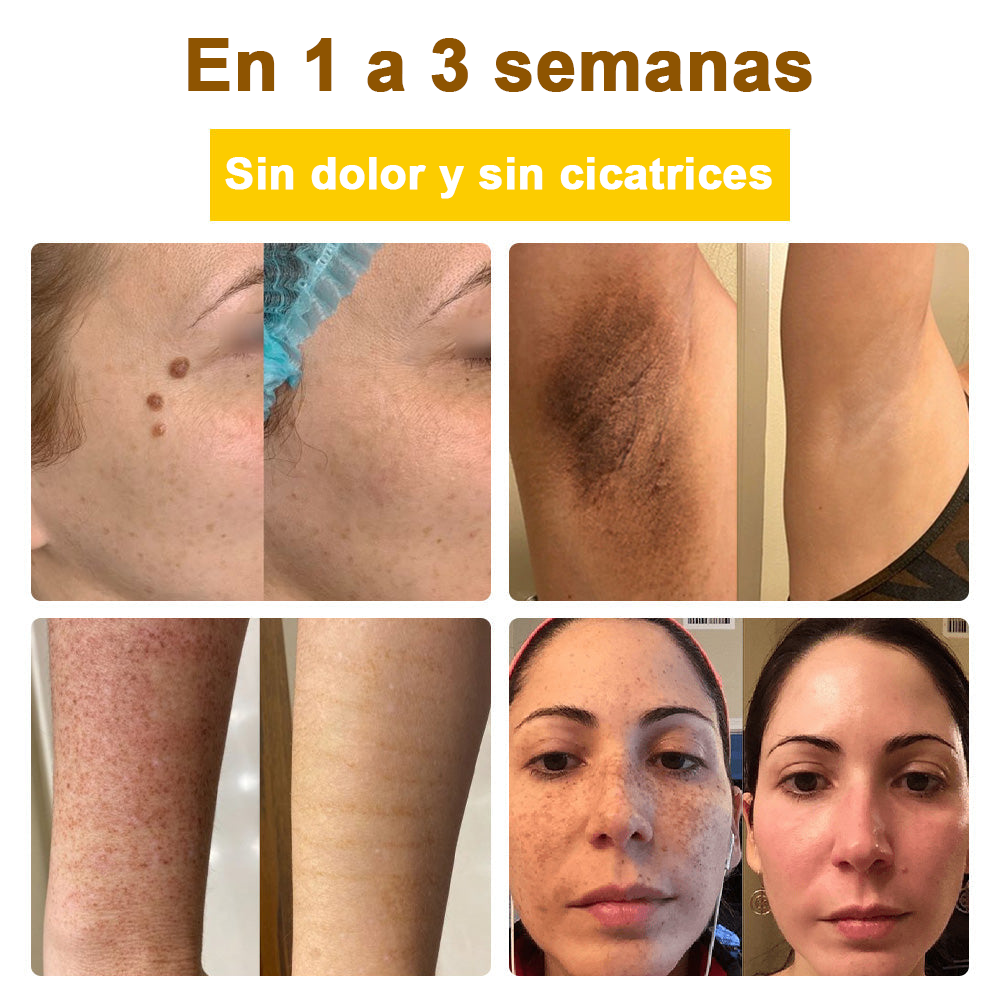 Crema cicatrizante ✅flysmus™ con veneno de abeja🐝: Tratamiento de eczemas, psoriasis, acné, rosácea, infecciones fúngicas y verrugas