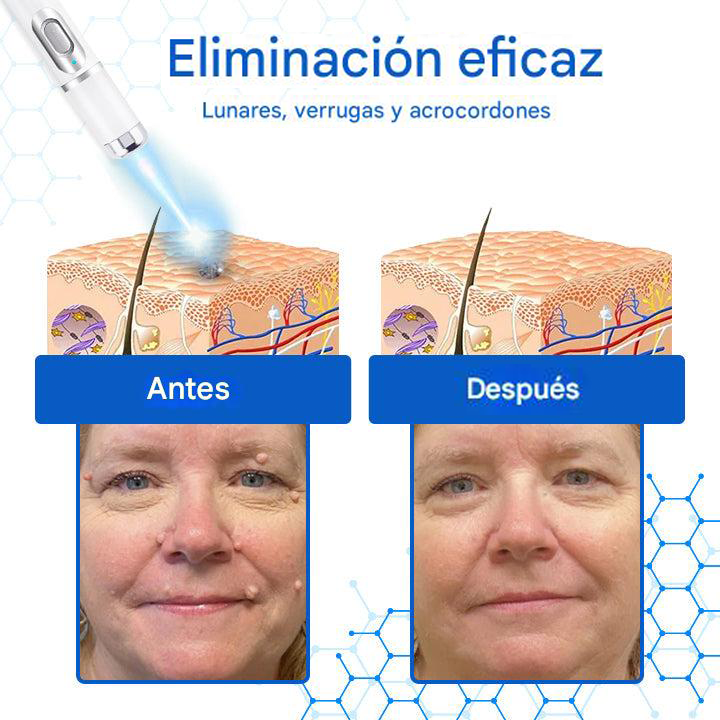 Mresio® DermZap Mole & Wart Removal Laser Pen💎