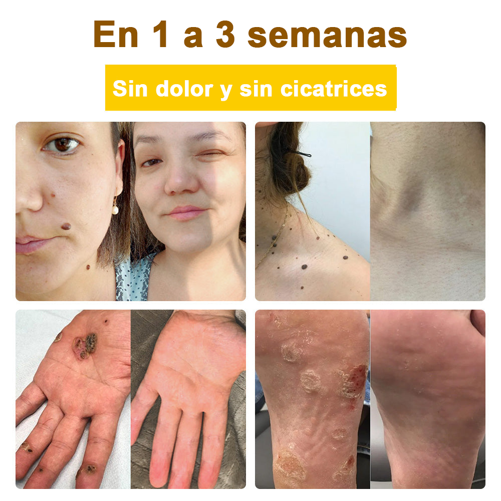 Crema cicatrizante ✅flysmus™ con veneno de abeja🐝: Tratamiento de eczemas, psoriasis, acné, rosácea, infecciones fúngicas y verrugas