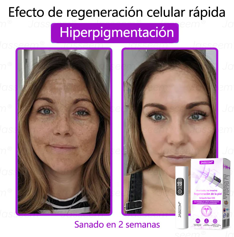 𝐉𝐚𝐬𝐬𝐞𝐞𝐦® Bolígrafo láser CO₂ avanzado y no invasivo para el cuidado de la piel 🛫 (Elimina suavemente verrugas, lunares, manchas de la edad y bultitos en la piel – ¡sin dolor y sin complicaciones!) 🛫