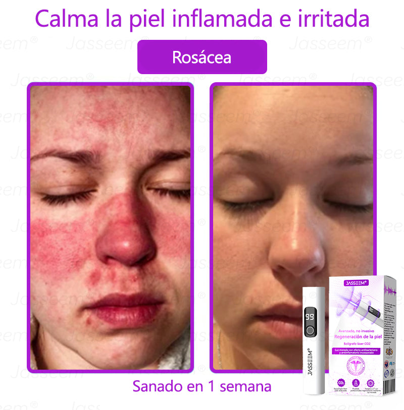 𝐉𝐚𝐬𝐬𝐞𝐞𝐦® Bolígrafo láser CO₂ avanzado y no invasivo para el cuidado de la piel 🛫 (Elimina suavemente verrugas, lunares, manchas de la edad y bultitos en la piel – ¡sin dolor y sin complicaciones!) 🛫