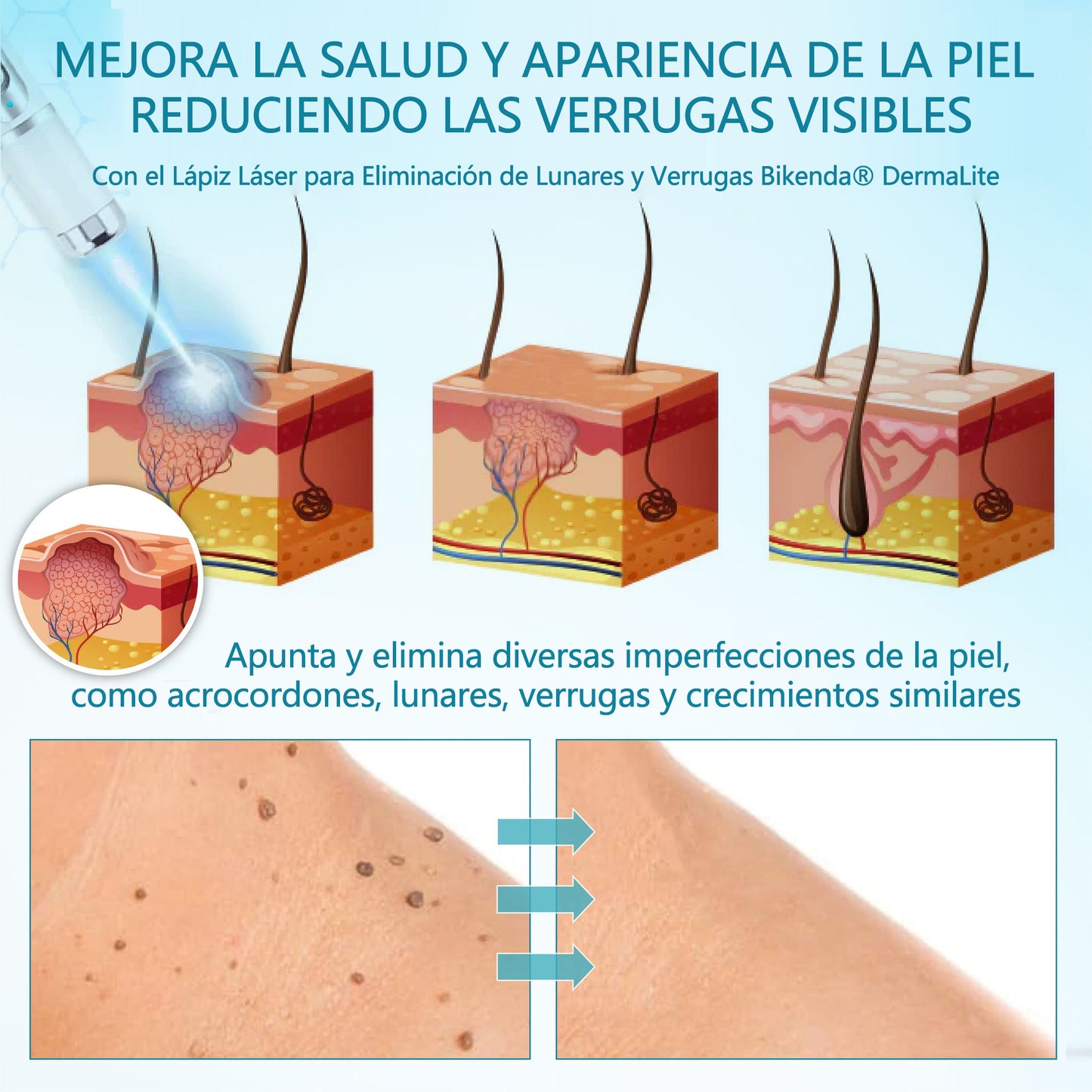 Bikenda® DermaLite Lápiz Láser Indoloro para Quitar Lunares🖊