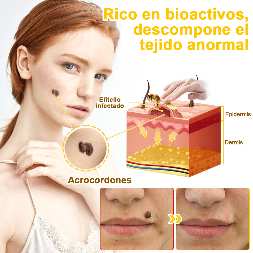 Crema cicatrizante ✅flysmus™ con veneno de abeja🐝: Tratamiento de eczemas, psoriasis, acné, rosácea, infecciones fúngicas y verrugas
