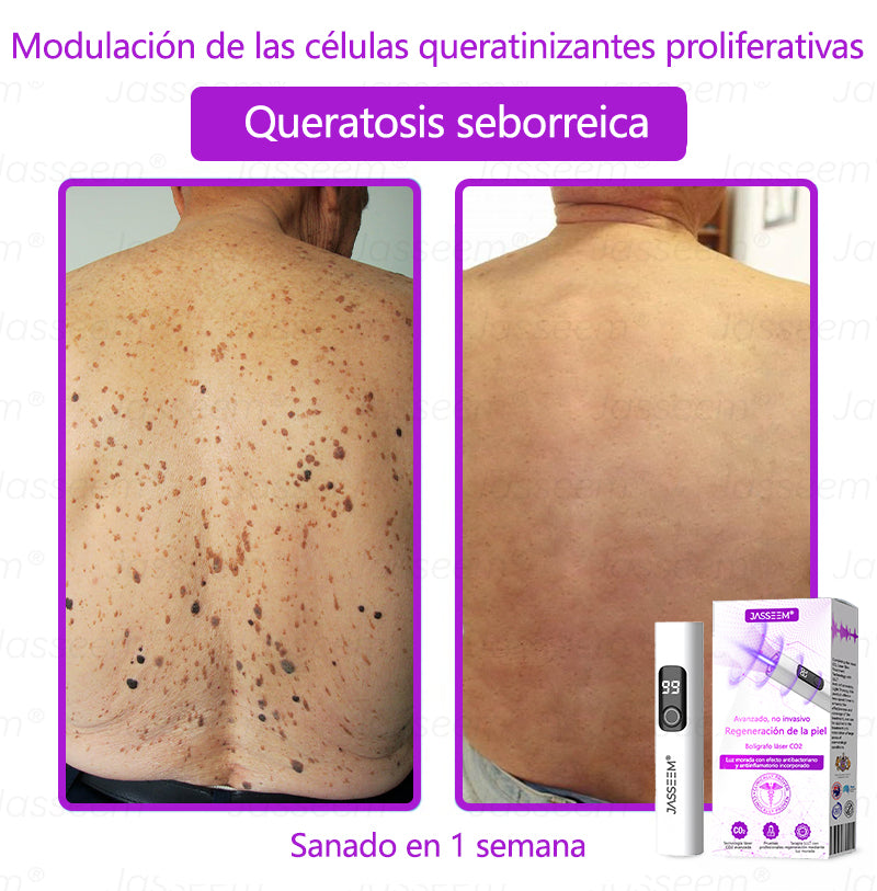 𝐉𝐚𝐬𝐬𝐞𝐞𝐦® Bolígrafo láser CO₂ avanzado y no invasivo para el cuidado de la piel 🛫 (Elimina suavemente verrugas, lunares, manchas de la edad y bultitos en la piel – ¡sin dolor y sin complicaciones!) 🛫