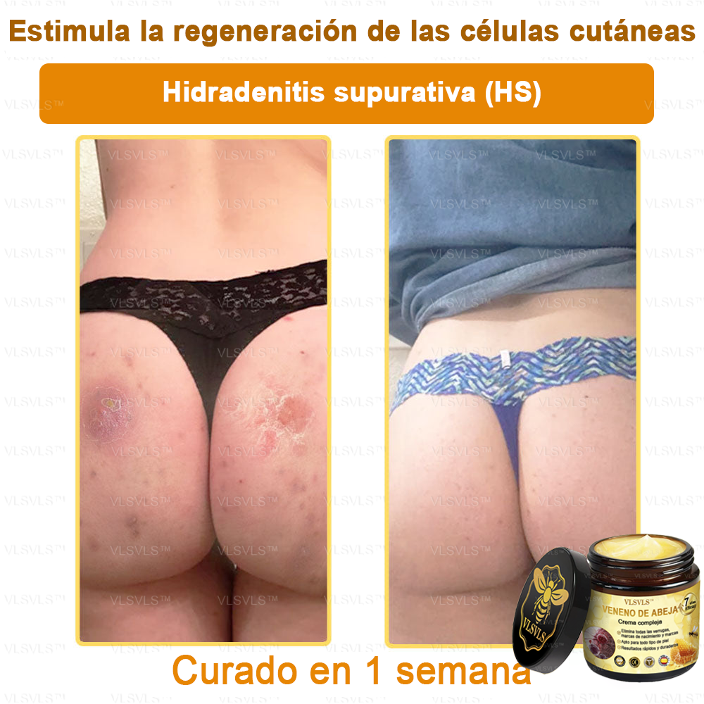 VLSVLS™ Crema con Veneno de Abeja de Efecto Completo 🧑⚕️ Recomendado por Dermatólogos - Para el Tratamiento de Diversos Problemas de la Piel🐝