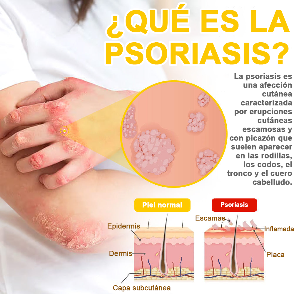 Crema cicatrizante ✅flysmus™ con veneno de abeja🐝: Tratamiento de eczemas, psoriasis, acné, rosácea, infecciones fúngicas y verrugas