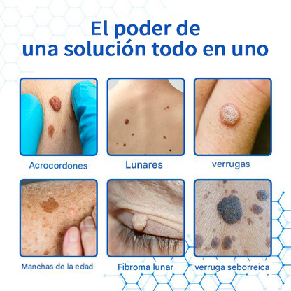 Mresio® DermZap Mole & Wart Removal Laser Pen💎