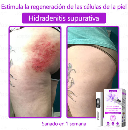 𝐉𝐚𝐬𝐬𝐞𝐞𝐦® Bolígrafo láser CO₂ avanzado y no invasivo para el cuidado de la piel (Elimina suavemente verrugas, lunares, manchas de la edad y bultitos en la piel – ¡sin dolor y sin complicaciones!)🛫
