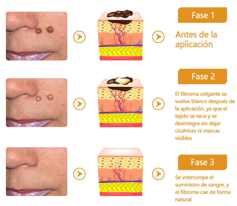 🐝Twinsun™ Súper Crema Potente con Veneno de Abeja, ¡aprobada por la EMA! 💖Perfecta para tratar verrugas, bultitos en la piel, infecciones, queratosis… ¡y para dejarte la piel suave y uniforme!