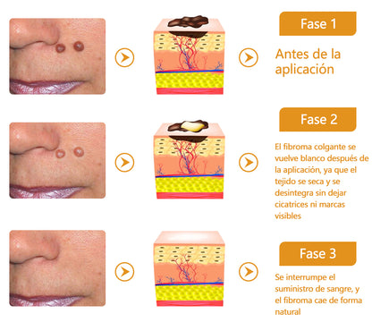 🐝Twinsun™ Súper Crema Potente con Veneno de Abeja, ¡aprobada por la EMA! 💖Perfecta para tratar verrugas, bultitos en la piel, infecciones, queratosis… ¡y para dejarte la piel suave y uniforme!