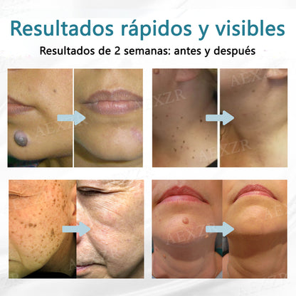 Bikenda® lápiz láser no invasivo para eliminar manchas y verrugas