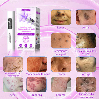 𝐉𝐚𝐬𝐬𝐞𝐞𝐦® Bolígrafo láser CO₂ avanzado y no invasivo para el cuidado de la piel (Elimina suavemente verrugas, lunares, manchas de la edad y bultitos en la piel – ¡sin dolor y sin complicaciones!)🛫