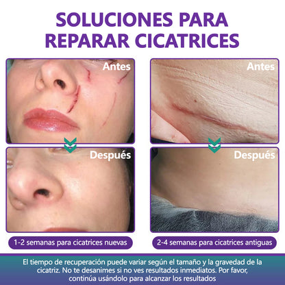 🏷️ Tienda Oficial: Flysmus® ReGen Cinta de Microneedles con Ácido Hialurónico Nano-Heal 💝 Tratamiento de cicatrices nuevas y antiguas, reducción de cicatrices quirúrgicas, estrías, queloides, acné, quemaduras, verrugas, dermatomas y venas varicosas