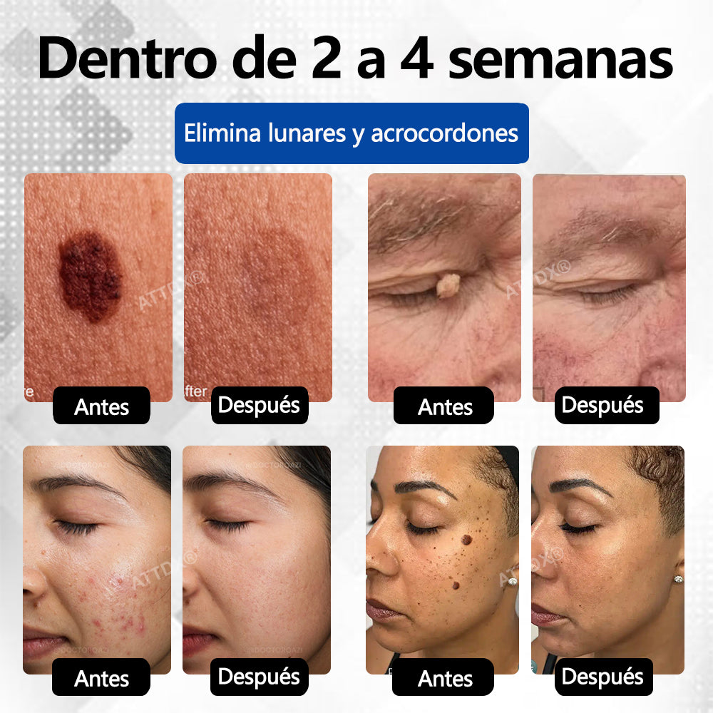 Bikenda® SpotAway Lápiz Láser Indoloro para Quitar Lunares✨✨