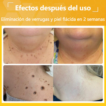 🐝Twinsun™ Súper Crema Potente con Veneno de Abeja, ¡aprobada por la EMA! 💖Perfecta para tratar verrugas, bultitos en la piel, infecciones, queratosis… ¡y para dejarte la piel suave y uniforme!