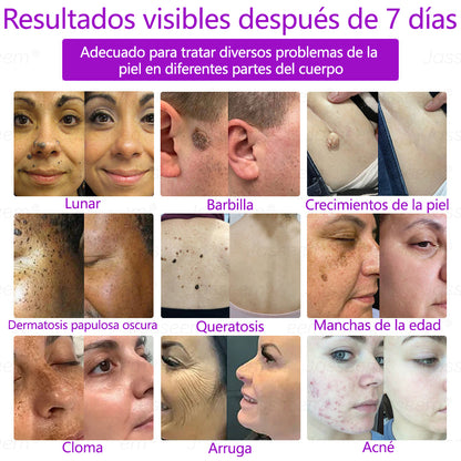 𝐉𝐚𝐬𝐬𝐞𝐞𝐦® Bolígrafo láser CO₂ avanzado y no invasivo para el cuidado de la piel (Elimina suavemente verrugas, lunares, manchas de la edad y bultitos en la piel – ¡sin dolor y sin complicaciones!)🛫