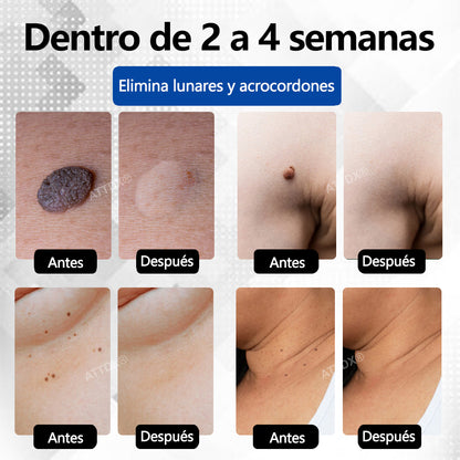 Bikenda® SpotAway Lápiz Láser Indoloro para Quitar Lunares✨✨