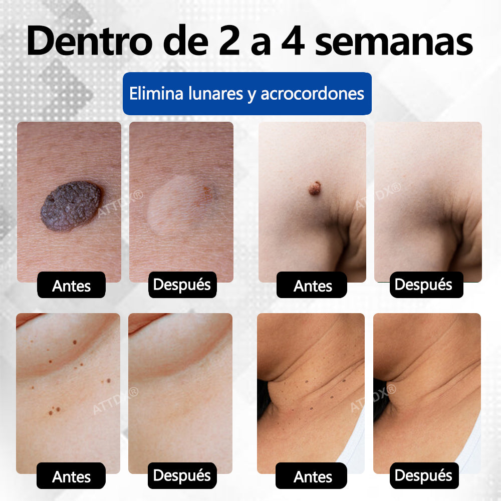 Bikenda® DermaLite Lápiz Láser Indoloro para Quitar Lunares🖊