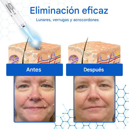 Mresio® DermZap Mole & Wart Removal Laser Pen💎