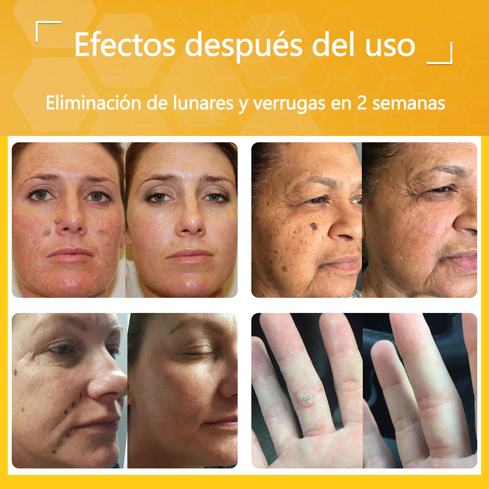 🐝Twinsun™ Súper Crema Potente con Veneno de Abeja, ¡aprobada por la EMA! 💖Perfecta para tratar verrugas, bultitos en la piel, infecciones, queratosis… ¡y para dejarte la piel suave y uniforme!