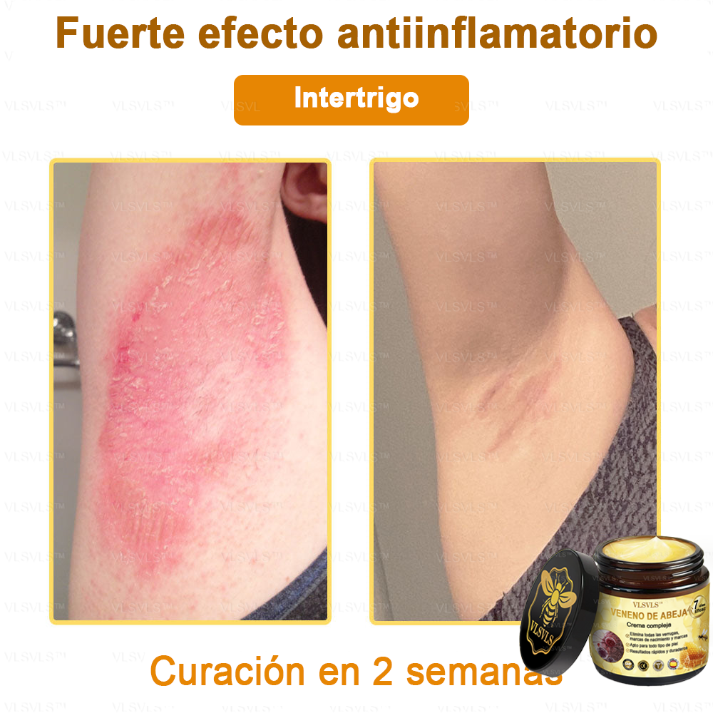 VLSVLS™ Crema con Veneno de Abeja de Efecto Completo 🧑‍⚕️ Recomendado por Dermatólogos - Para el Tratamiento de Diversos Problemas de la Piel🐝