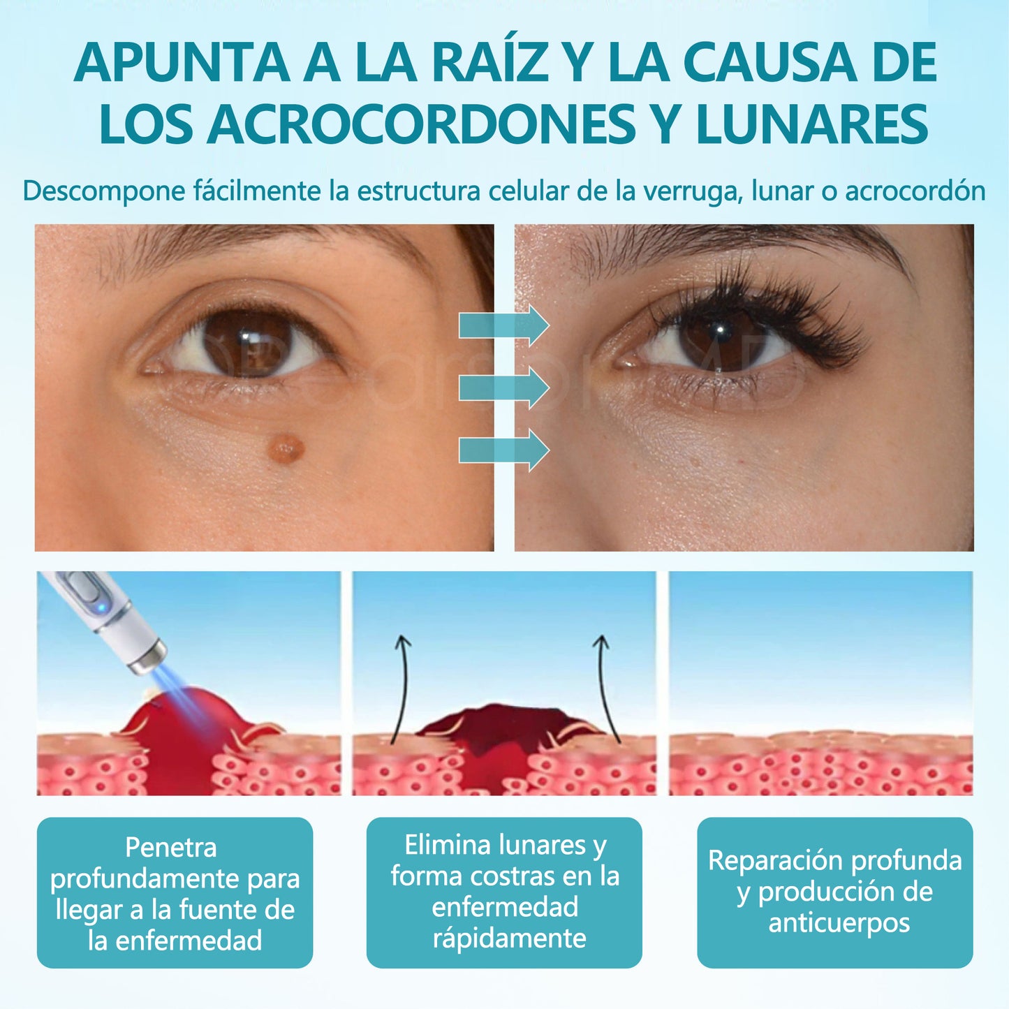 Bikenda® DermaLite Lápiz Láser Indoloro para Quitar Lunares🖊