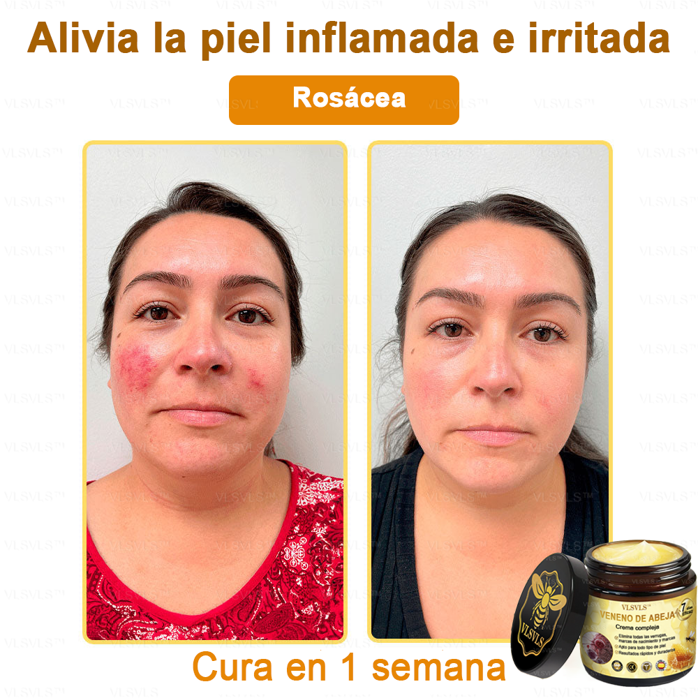 VLSVLS™ Crema con Veneno de Abeja de Efecto Completo 🧑‍⚕️ Recomendado por Dermatólogos - Para el Tratamiento de Diversos Problemas de la Piel🐝