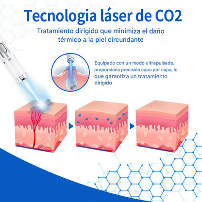 Mresio® DermZap Mole & Wart Removal Laser Pen💎