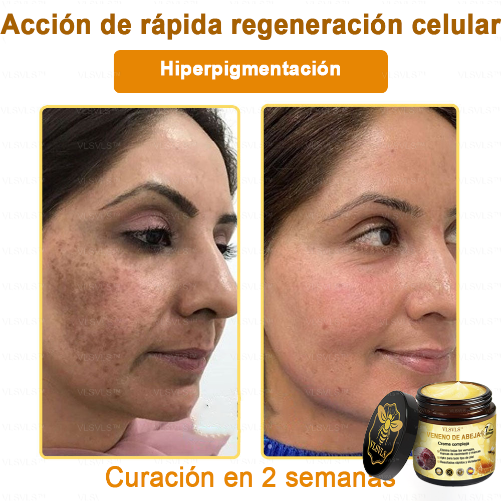 VLSVLS™ Crema con Veneno de Abeja de Efecto Completo 🧑‍⚕️ Recomendado por Dermatólogos - Para el Tratamiento de Diversos Problemas de la Piel🐝