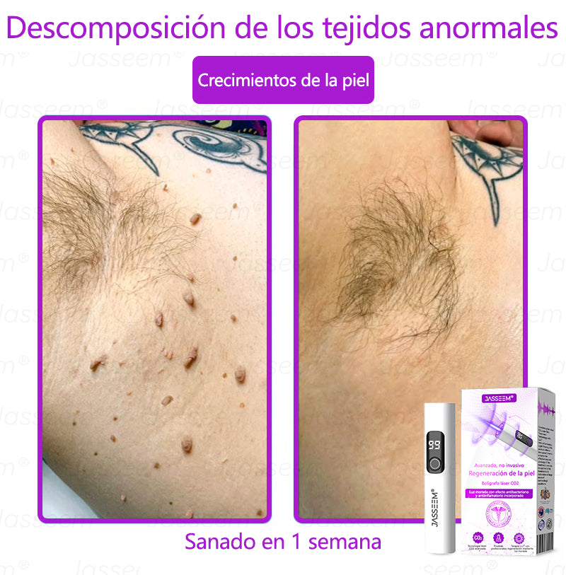 𝐉𝐚𝐬𝐬𝐞𝐞𝐦® Bolígrafo láser CO₂ avanzado y no invasivo para el cuidado de la piel (Elimina suavemente verrugas, lunares, manchas de la edad y bultitos en la piel – ¡sin dolor y sin complicaciones!)🛫